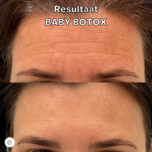 baby botox voorhoofd