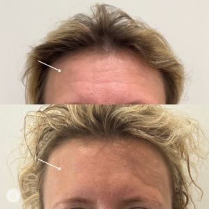 botox voorhoofd vrouw voor en na resultaat