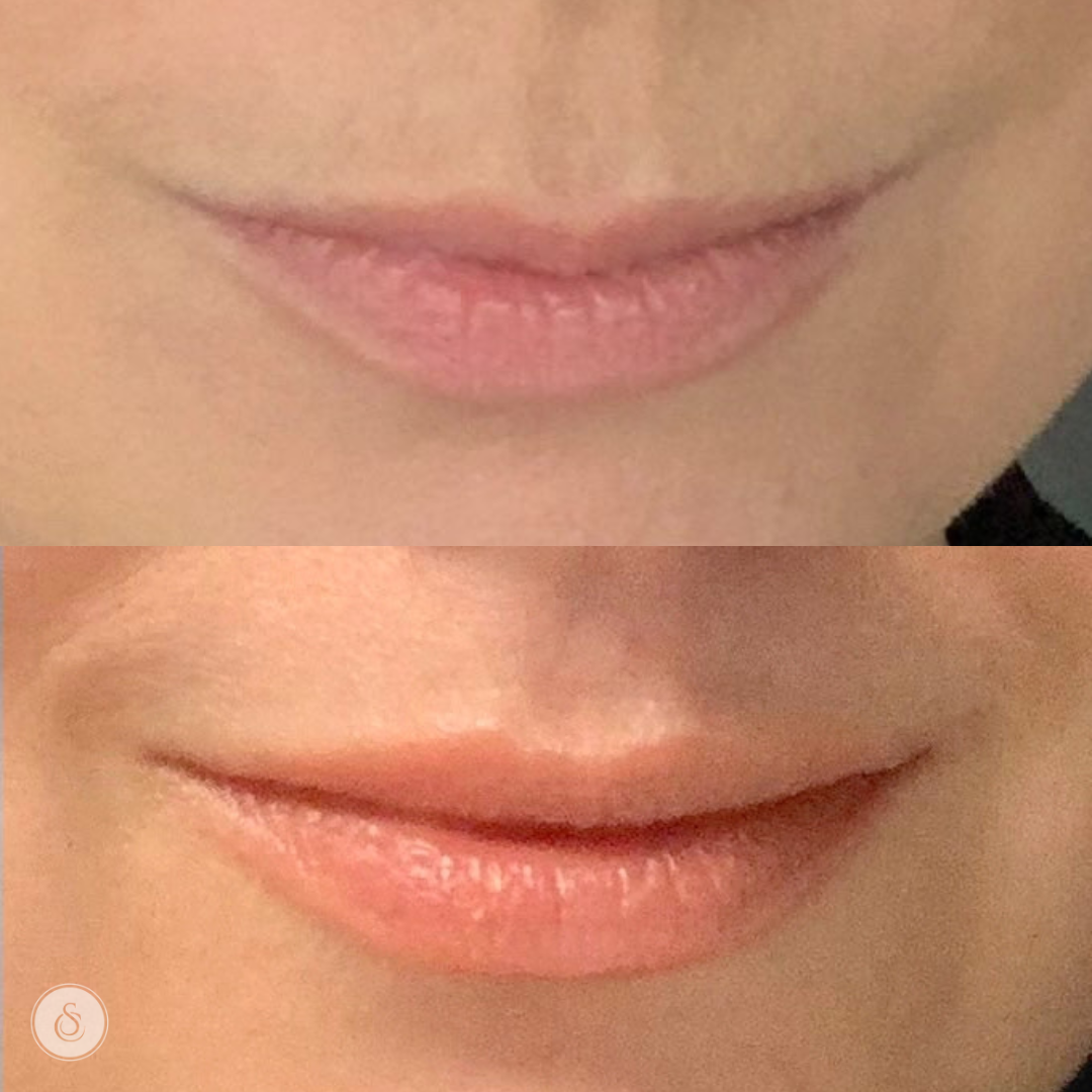 Lipflip behandeling botox gent