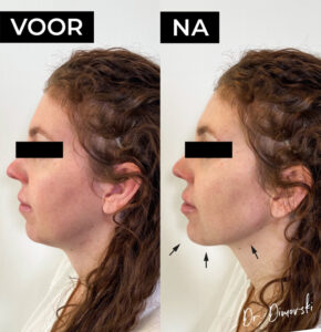 SarasinClinic-liquid-facelift-1