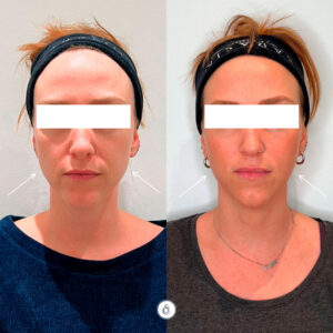 SarasinClinic_Nefertiti-Halslift-Face-Slimming_front