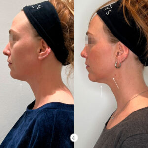 SarasinClinic_Nefertiti-Halslift_Face-Slimming-profiel