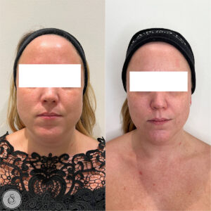 SarasinClinic_face-slimming-masseter-tox