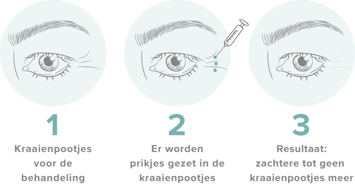 SarasinClinic_kraaienpootjes_behandeling